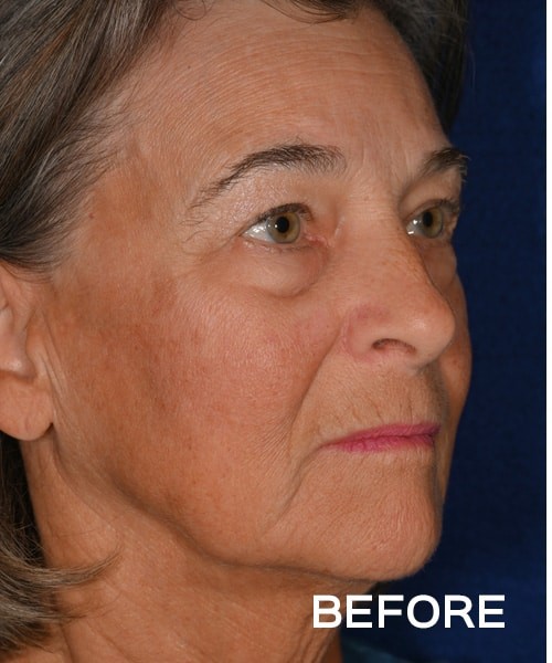 Deep Plane Facelift before and after - before