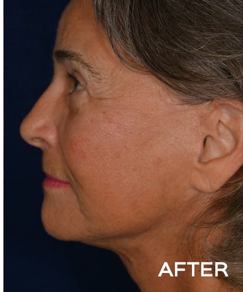 Deep Plane Facelift before and after - after