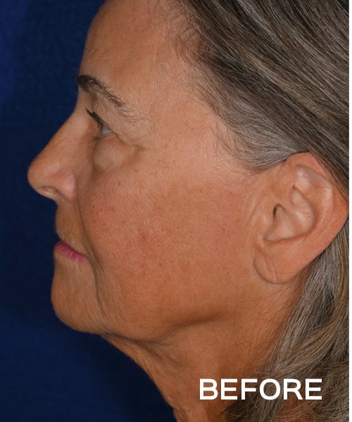 Deep Plane Facelift before and after - before