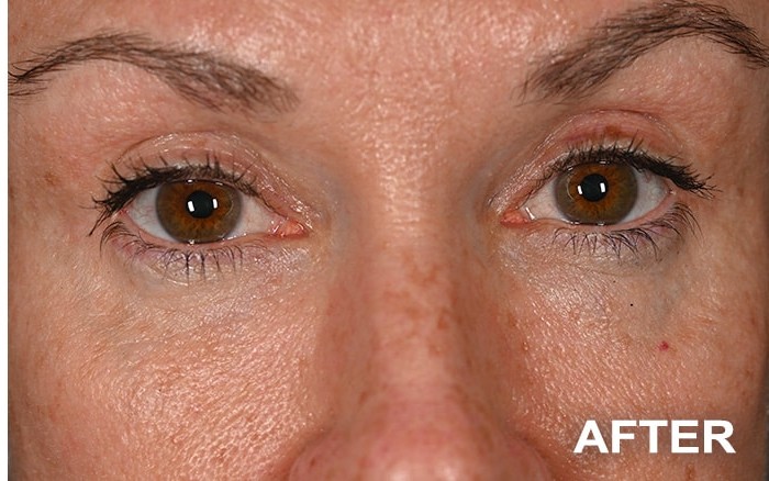 Lower Blepharoplasty before and after - after