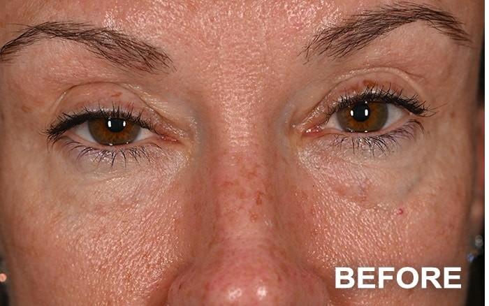 Lower Blepharoplasty before and after - before