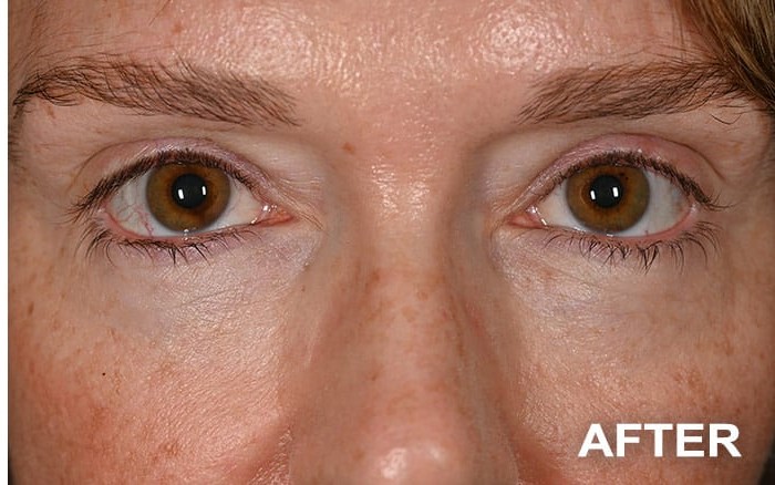 Lower Blepharoplasty before and after - after