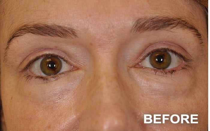 Lower Blepharoplasty before and after - before