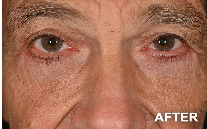 Lower Blepharoplasty Bilateral before and after - after