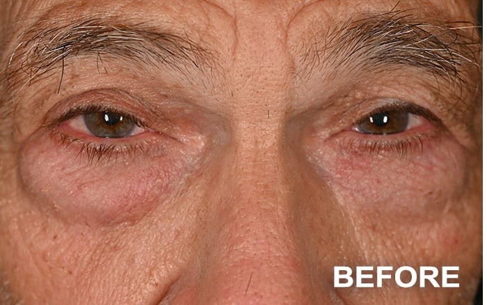Lower Blepharoplasty Bilateral before and after - before