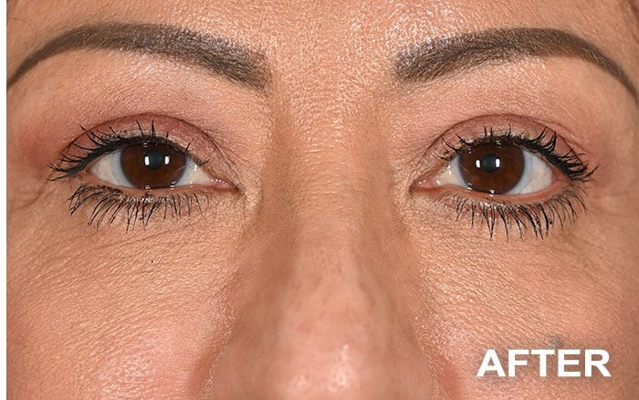 Lower Blepharoplasty Bilateral before and after - after
