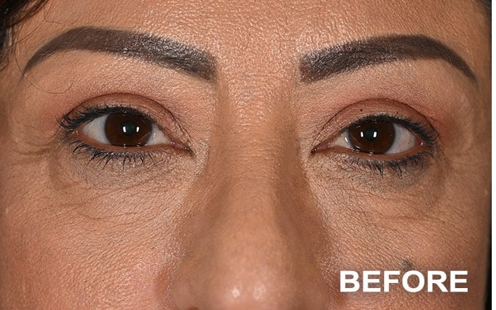 Lower Blepharoplasty Bilateral before and after - before