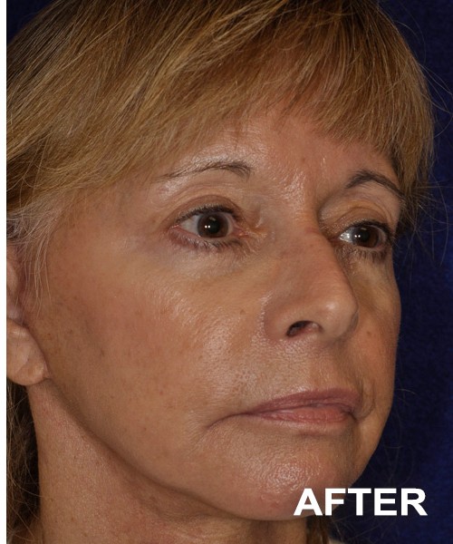 Facelift after — Dr. Harry Marshak