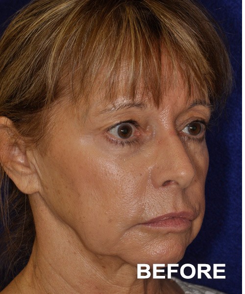 Facelift before — Dr. Harry Marshak