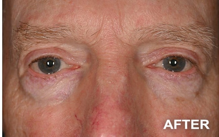 Repair of Mechanical Ptosis with Upper Blepharoplasty, Bilateral before and after - after
