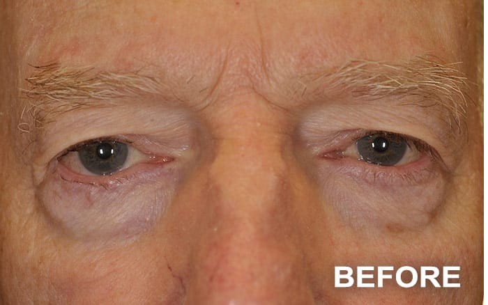 Repair of Mechanical Ptosis with Upper Blepharoplasty, Bilateral before and after - before