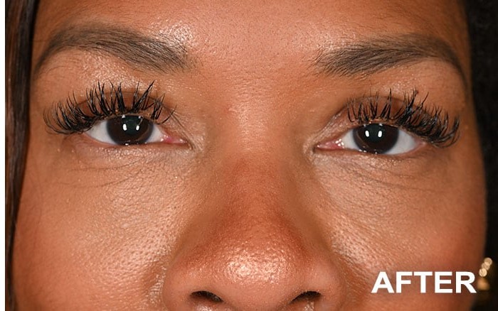 Repair of Mechanical Ptosis with Upper Blepharoplasty, Bilateral before and after - after