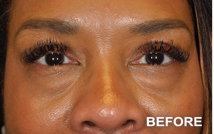 Repair of Mechanical Ptosis with Upper Blepharoplasty, Bilateral before and after - before