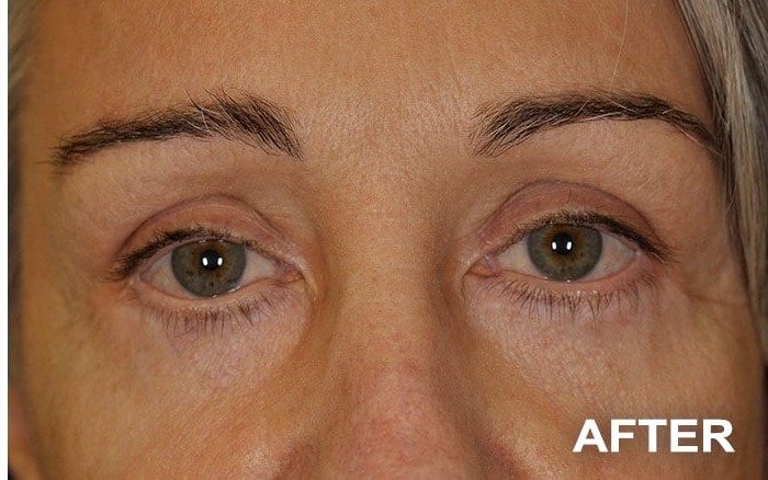 Lower Blepharoplasty before and after - after