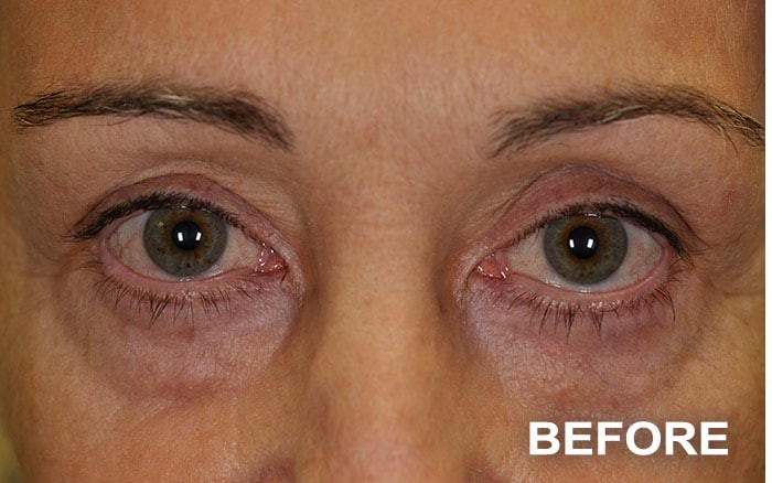 Lower Blepharoplasty before and after - before