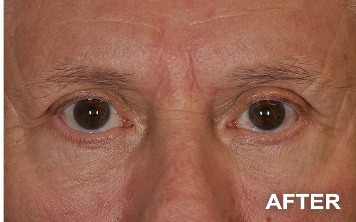 Lower Blepharoplasty before and after - after