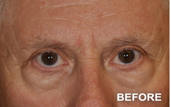 Lower Blepharoplasty before and after - before