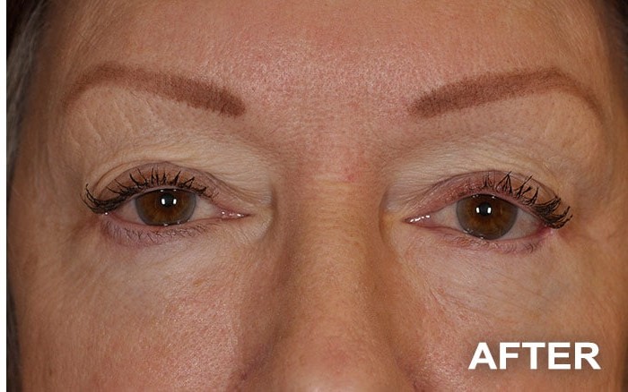 Lower Blepharoplasty before and after - after