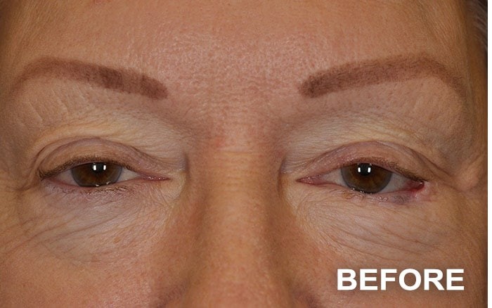 Lower Blepharoplasty before and after - before