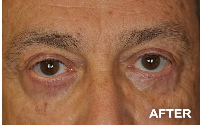 Lower Blepharoplasty before and after - after