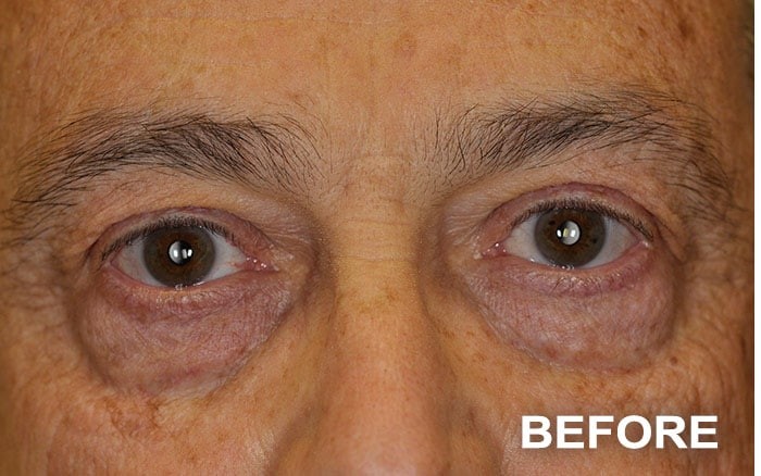 Lower Blepharoplasty before and after - before
