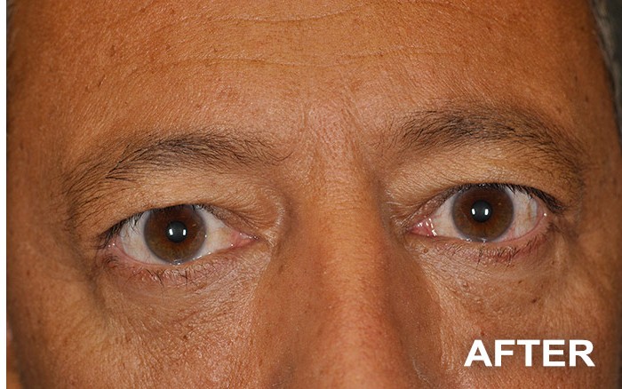 Lower Blepharoplasty before and after - after