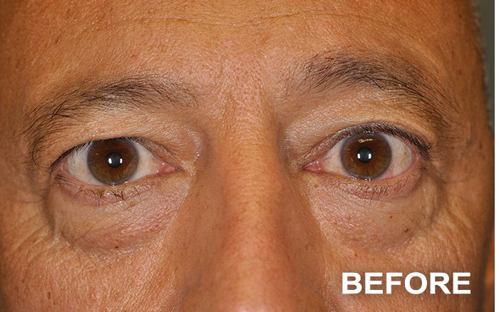 Lower Blepharoplasty before and after - before