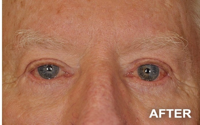 Lower Blepharoplasty before and after - after
