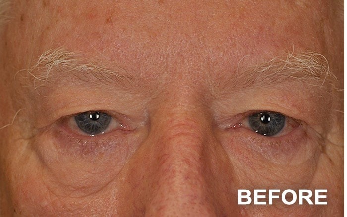 Lower Blepharoplasty before and after - before
