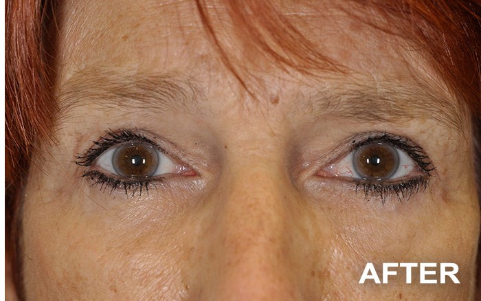 Upper and Lower Blepharoplasty before and after - after