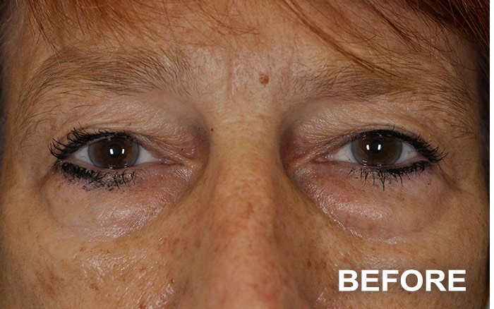 Upper and Lower Blepharoplasty before and after - before