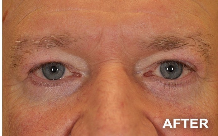 Upper and Lower Blepharoplasty before and after - after