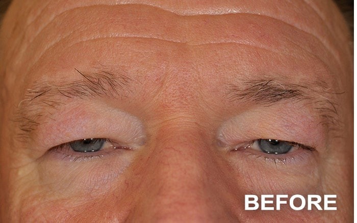 Upper and Lower Blepharoplasty before and after - before