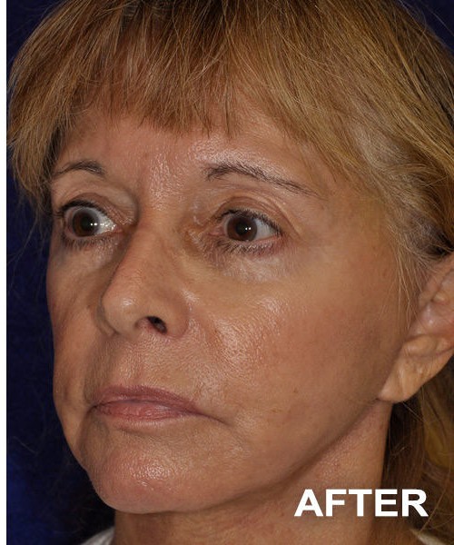 Facelift after — Dr. Harry Marshak
