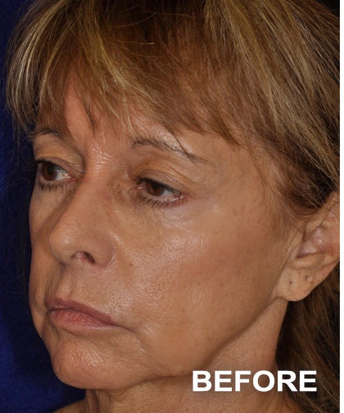 Facelift before — Dr. Harry Marshak