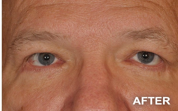 Ptosis Repair of the Upper Eyelids + Lower Blepharoplasty before and after - after
