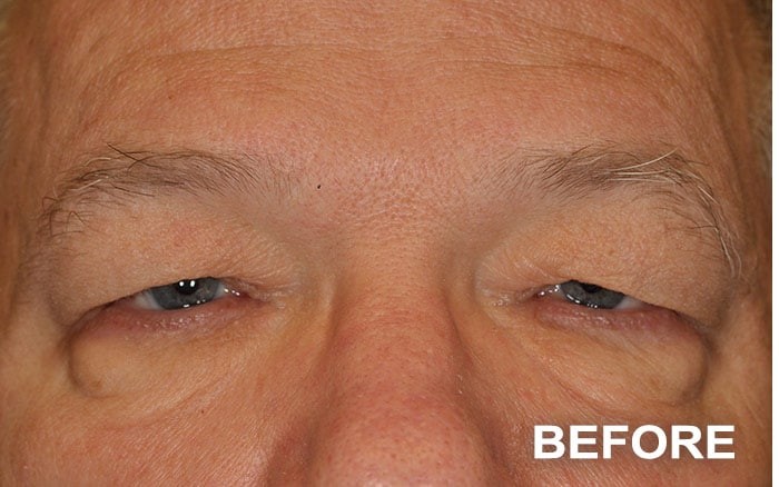 Ptosis Repair of the Upper Eyelids + Lower Blepharoplasty before and after - before
