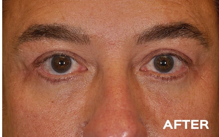 Ptosis Repair of the Upper Eyelids + Lower Blepharoplasty before and after - after