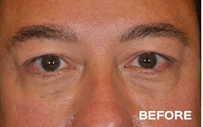 Ptosis Repair of the Upper Eyelids + Lower Blepharoplasty before and after - before