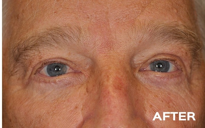 Lower Blepharoplasty with Fat Repositioning Bilateral before and after - after