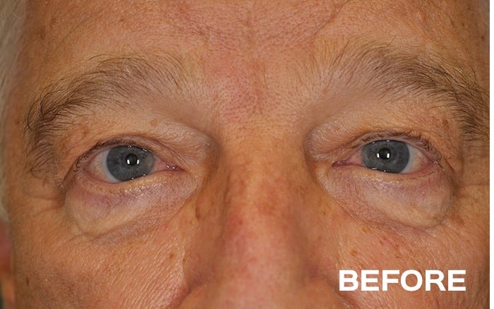 Lower Blepharoplasty with Fat Repositioning Bilateral before and after - before