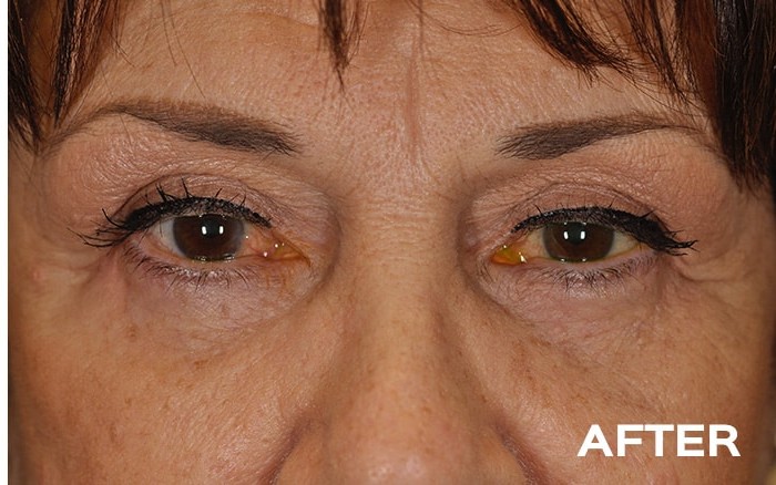 Lower Blepharoplasty with Fat Repositioning Bilateral before and after - after
