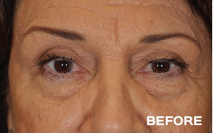 Lower Blepharoplasty with Fat Repositioning Bilateral before and after - before