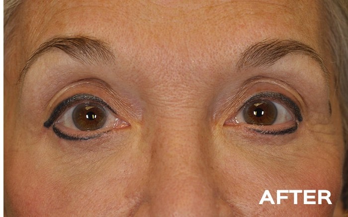 Lower Blepharoplasty with Fat Repositioning before and after - after