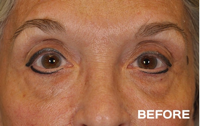 Lower Blepharoplasty with Fat Repositioning before and after - before