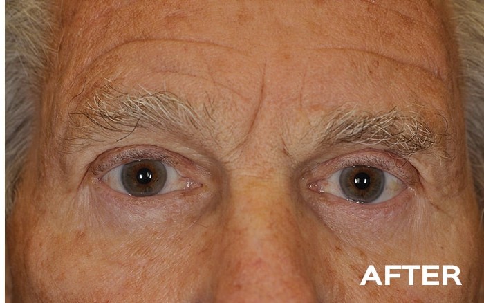 Lower Blepharoplasty with Fat Repositioning before and after - after