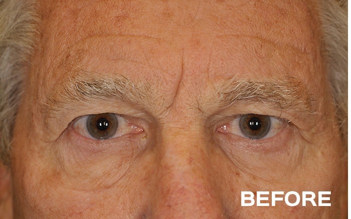 Lower Blepharoplasty with Fat Repositioning before and after - before
