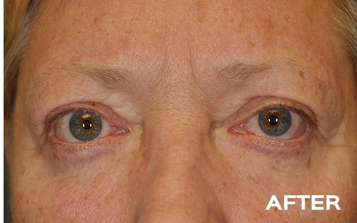 Upper and Lower Blepharoplasty before and after - after