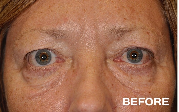 Upper and Lower Blepharoplasty before and after - before