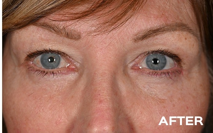 Upper and Lower Blepharoplasty before and after - after